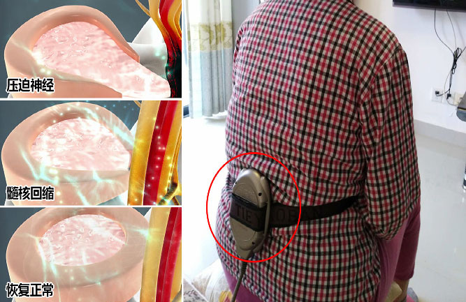 鐵腰板治療儀真的有效果 鐵腰板治療儀真的有效果