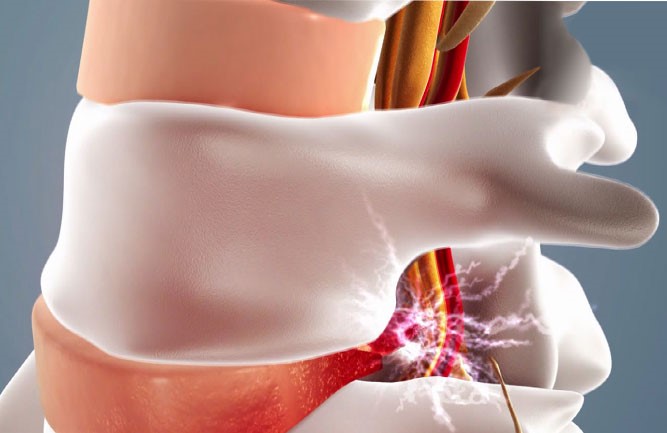 治療腰突主要方法有哪些 治療腰突主要方法有哪些