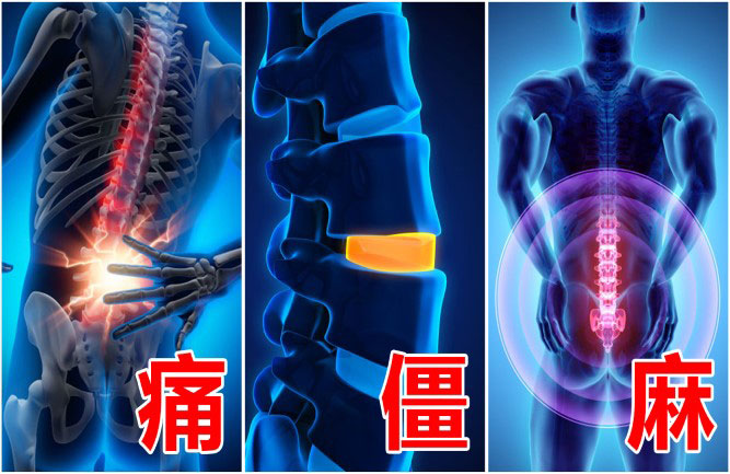 腰椎間盤突出最好的鍛煉方法有哪些 腰椎間盤突出最好的鍛煉方法有哪些