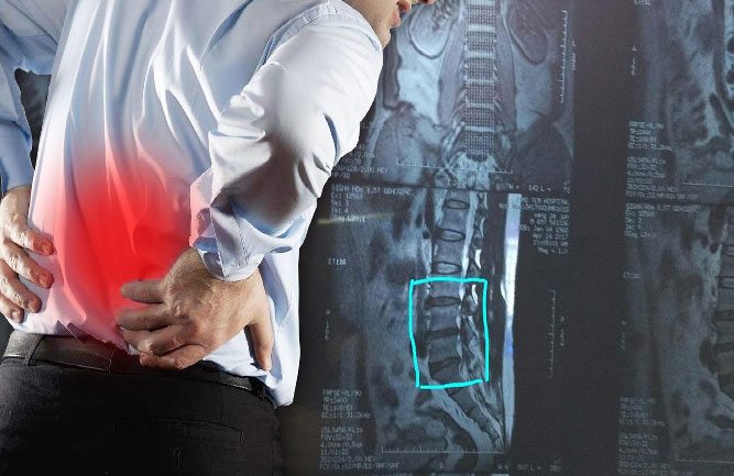 腰間盤突出癥狀表現(xiàn) 腰間盤突出癥狀表現(xiàn)