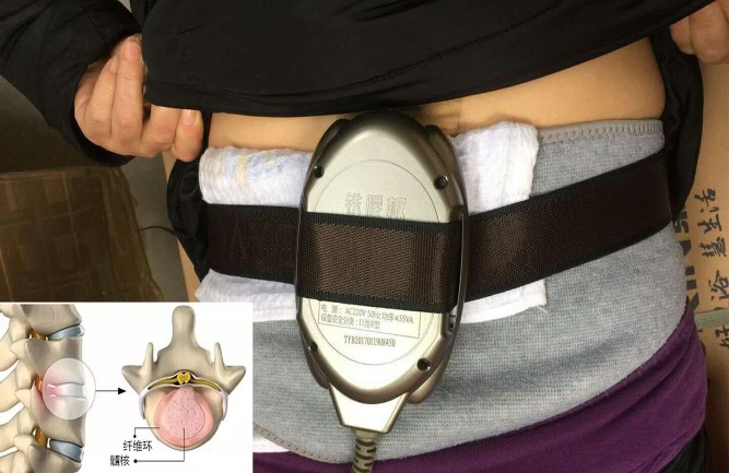 鐵腰板真的能治療腰間盤突出嗎 鐵腰板真的能治療腰間盤突出嗎